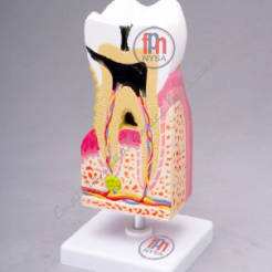 Model przekroju zęba trzonowego - stany chorobowe